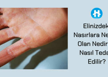 Elinizdeki Nasırlara Neden Olan Nedir ve Nasıl Tedavi Edilir?