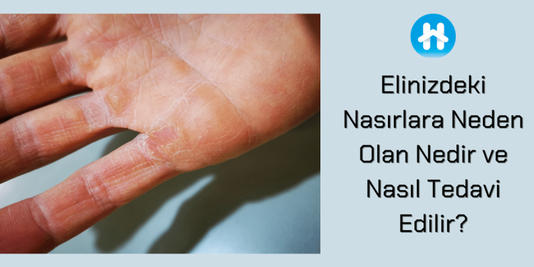 Elinizdeki Nasırlara Neden Olan Nedir ve Nasıl Tedavi Edilir? 1 Elinizdeki Nasırlara Neden Olan Nedir ve Nasıl Tedavi Edilir?